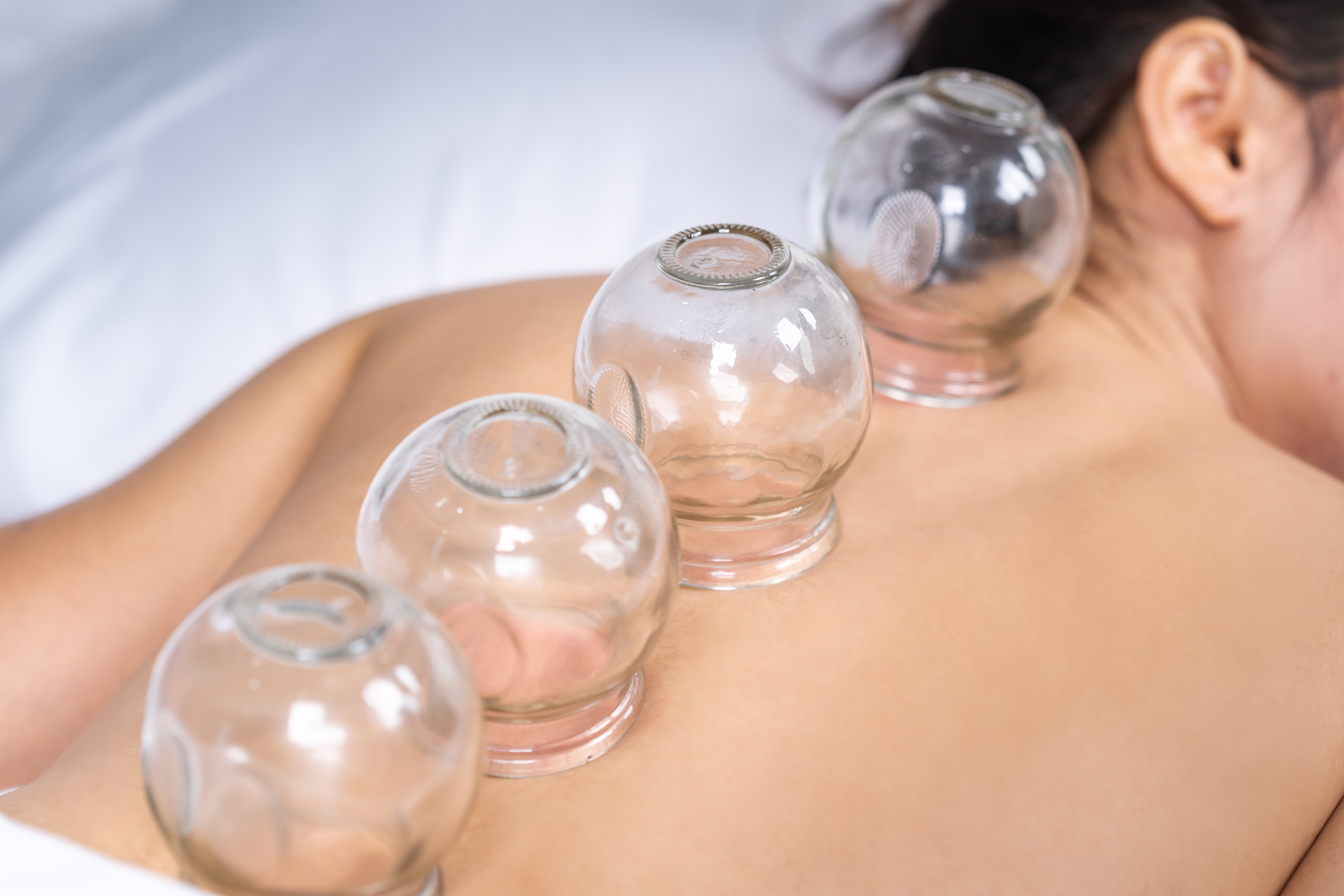  a woman lying down on her stomach with 4 glass cupping devices on her back